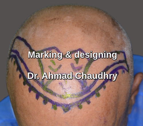 Baldness treatment area marking
