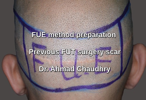 FUT hair restoration surgery scar Shakargarh