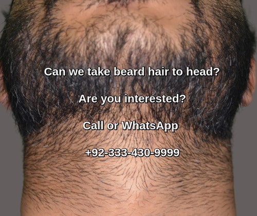 Hair transplant Gujranwala beard grafts
