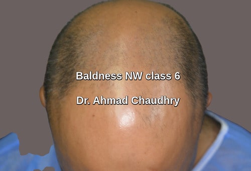 Hair transplant Multan road Lahore