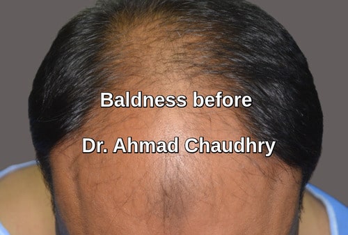 Hair transplant Riyadh