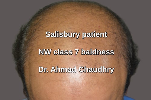 Hair transplant Salisbury United Kingdom
