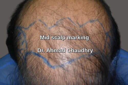 Hair transplant Shakargarh