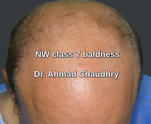 Hair transplant West Yorkshire