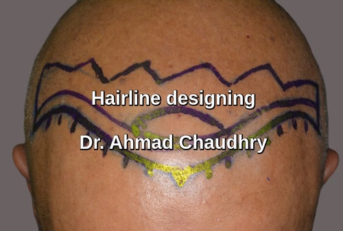 Hairline marking UK patient