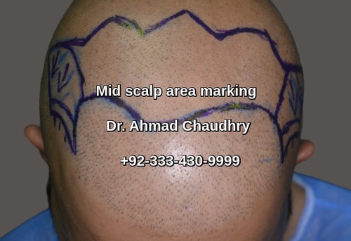 Mid scalp area marking District Narowal patient