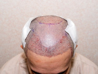 Top reasons to get fue hair transplant in Pakistan