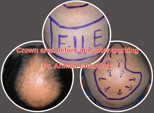 Hair transplant Southhall