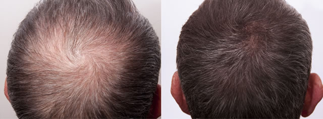 PRP before and after result