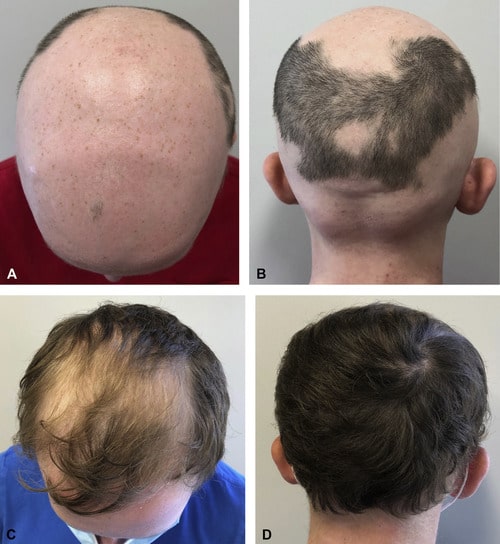 Ritlecitinib drug alopecia treatment