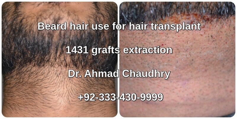 beard hair use Lahore