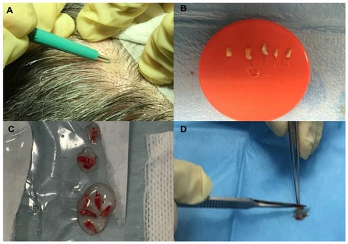 Autologous micrografts androgenetic alopecia Injection Pakistan