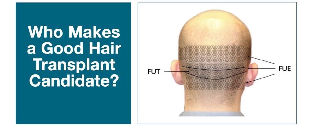 Best age for hair restoration surgery