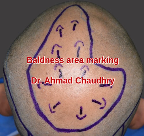 Crown baldness marking