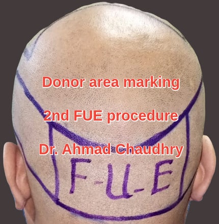 Fue Donor area marking abroad