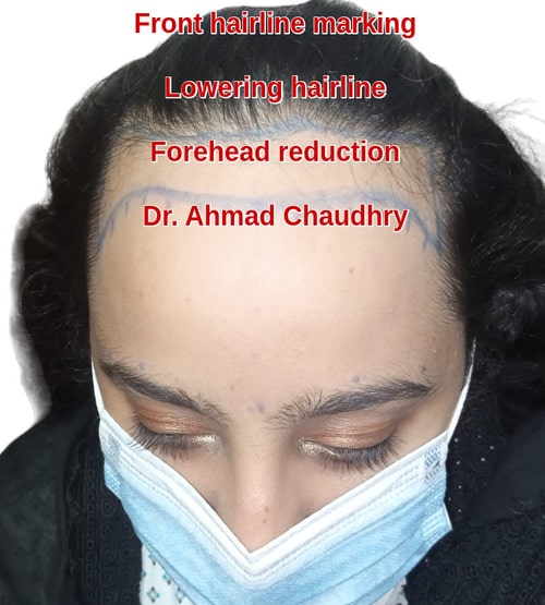 Female hair transplant Pakistan patient