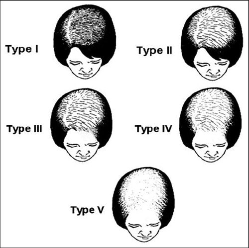 Female pattern baldness