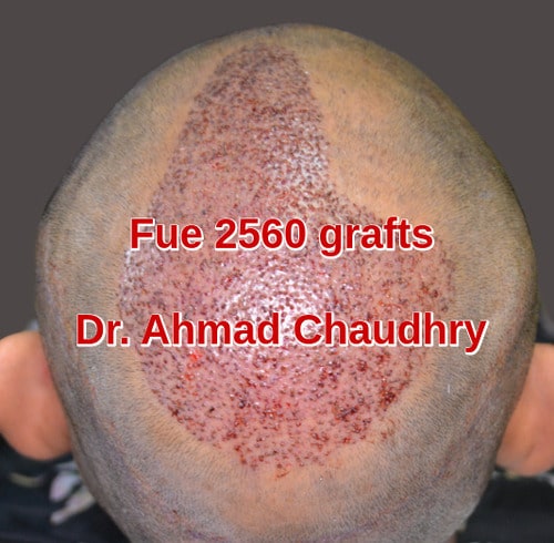 Fue 2560 grafts London patient