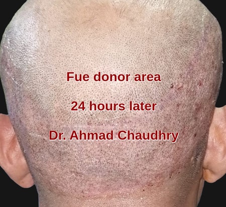 Fue donor area Portugal patient