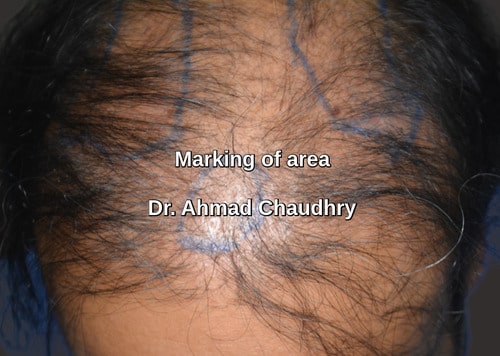 Hair transplant Abu Dhabi | 1524 grafts  Dirham per graft abroad