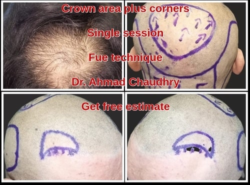 Hair transplant Durban patient