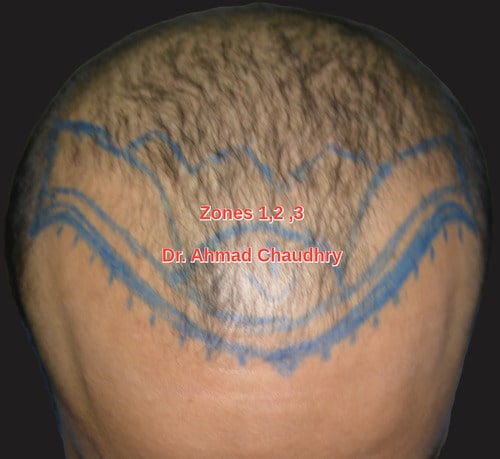 Hair transplant model town Lahore patient