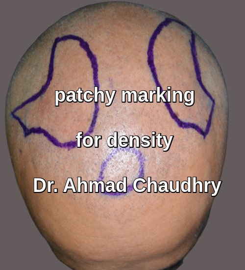 Male pattern baldness patchy marking