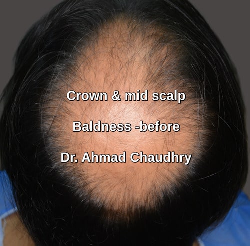 baldness crown area