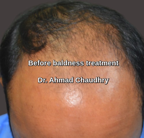 Before baldness treatment South Africa patient