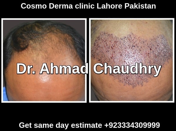 Hair transplant Johannesburg patient | 2500 grafts abroad call us