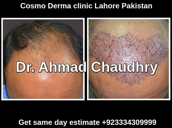 Hair transplant Johannesburg South Africa