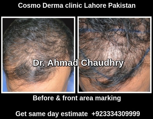 Hair transplant Melbourne patient