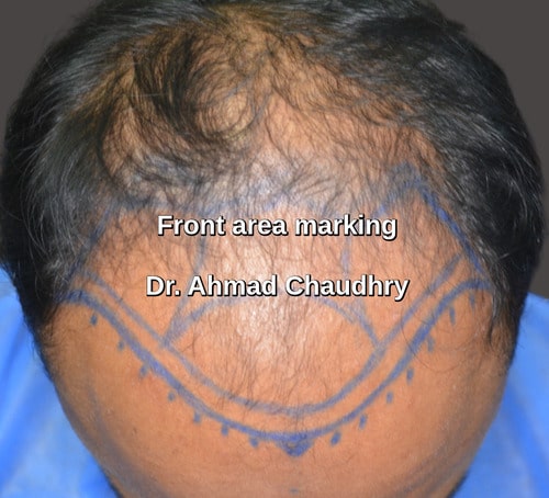 Marking front bald area