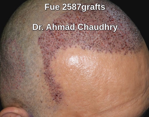 Right sided view after Fue procedure