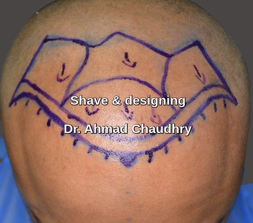 Shave & designing front baldness area