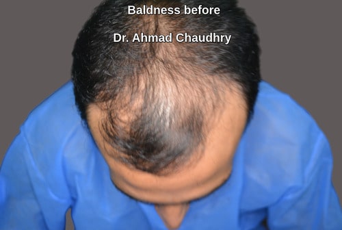 Baldness treatment marking