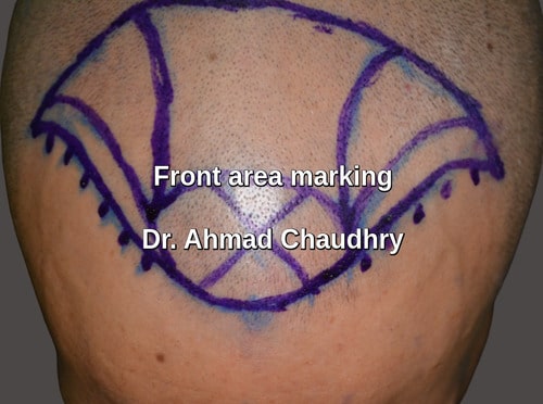 Front baldness area marking Gujrat