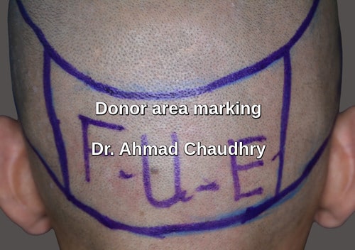 Fue donor area preparation