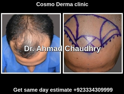 Fue hair transplant Gujrat patient before