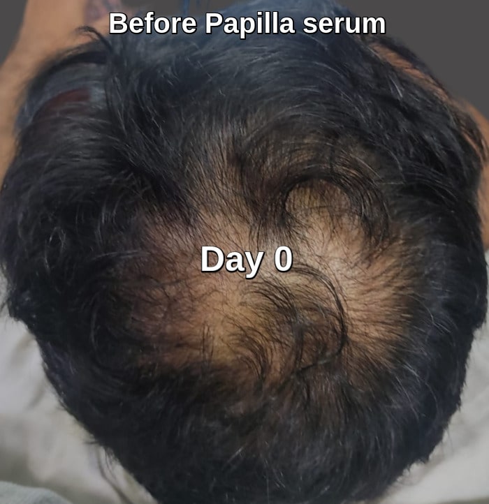 Before baldness treatment