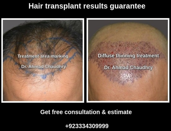 Hair transplant guarantee Pakistan