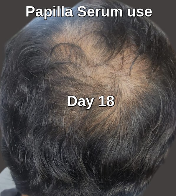 Topical Finasteride serum result 18 days later
