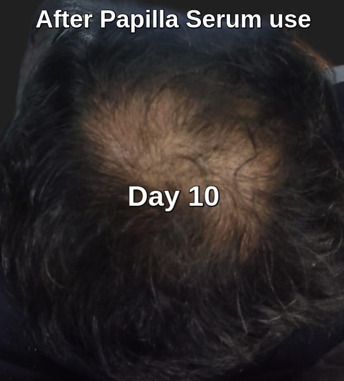 Topical Finasteride spray use 10 days later