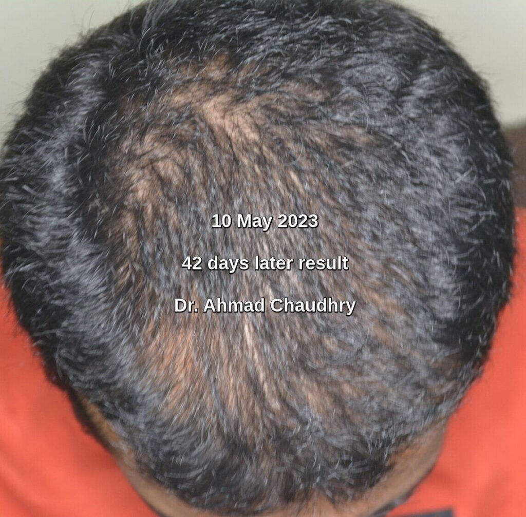 Hair treatment for men in Lahore result
