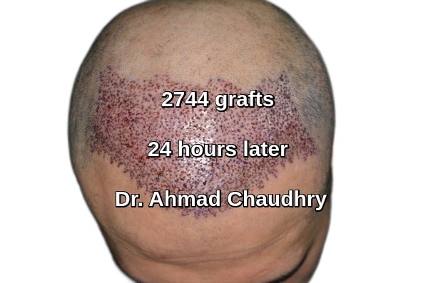 Fue hair transplant 2744 grafts Bolton patient