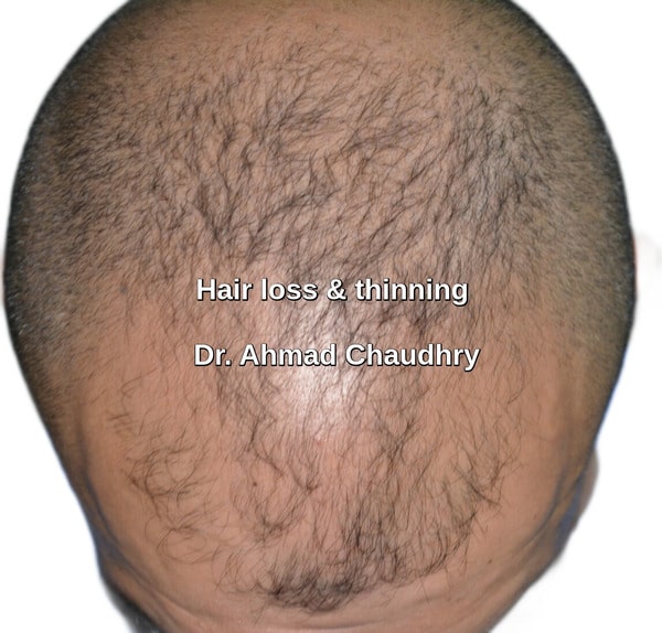 Hair loss United Kingdom patient