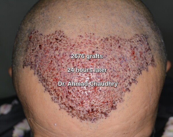 Hair restoration Luton patient