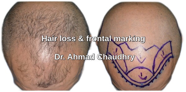 Hair transplant Luton UK patient