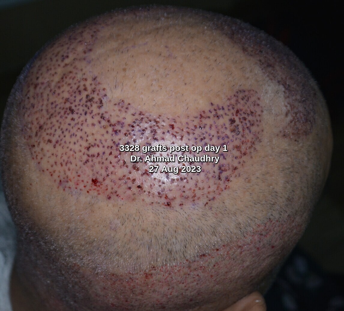 Fue hair transplant Rawalpindi Pakistan