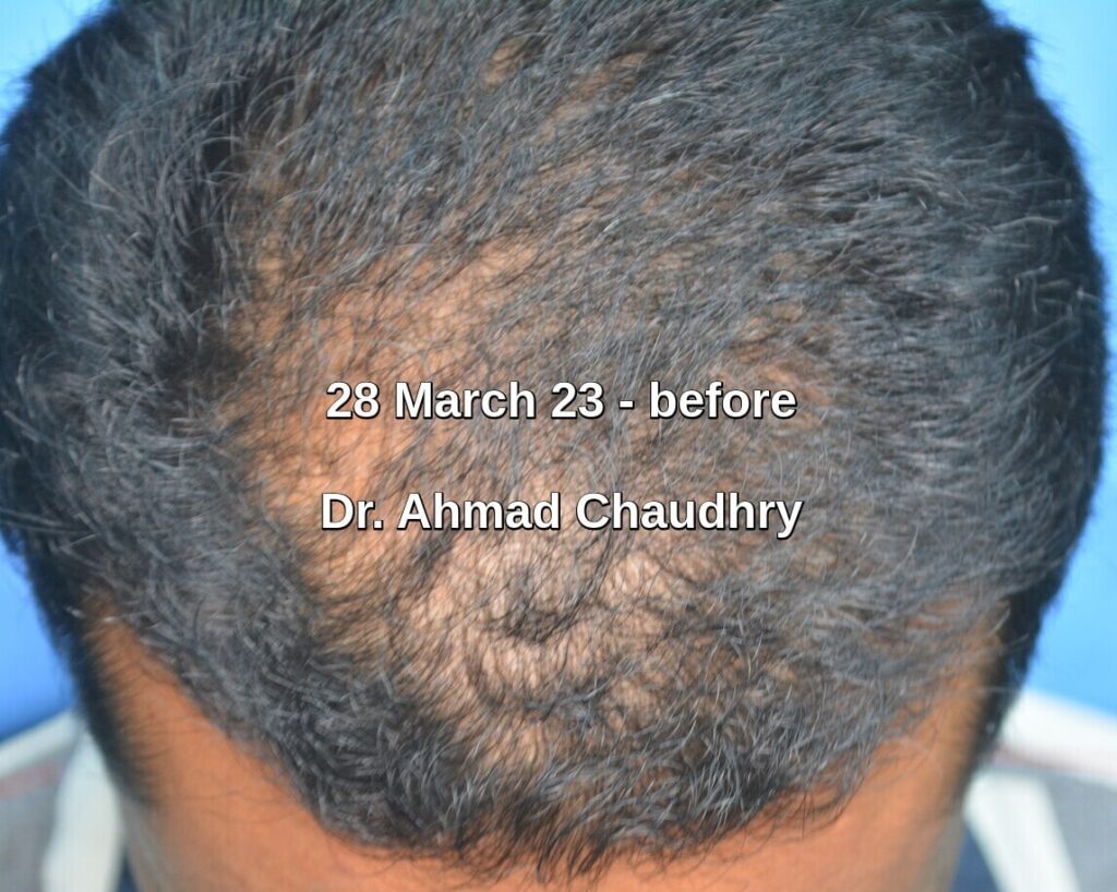 Hair loss and thinning